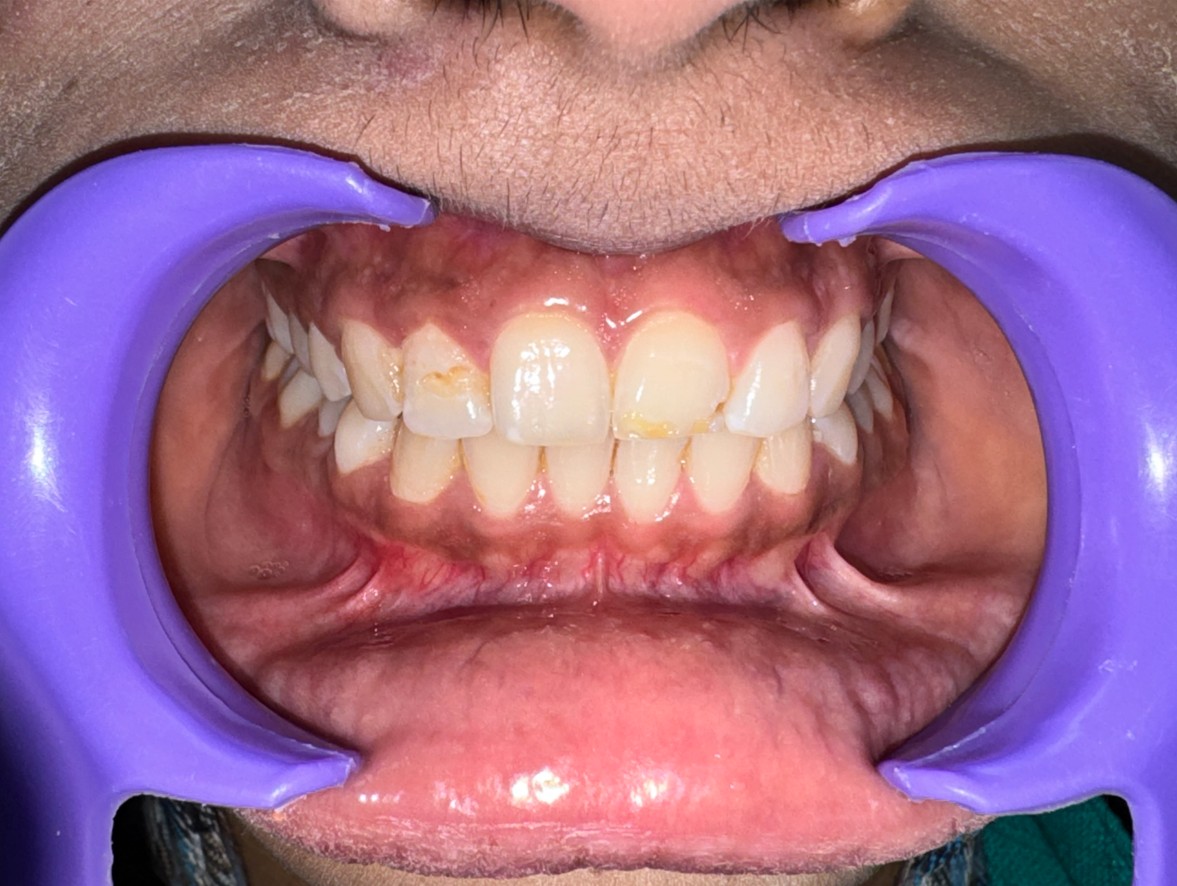 Discolouration case — before treatment