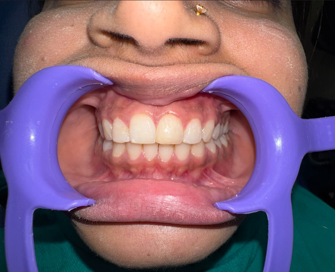 Discolouration case — after treatment