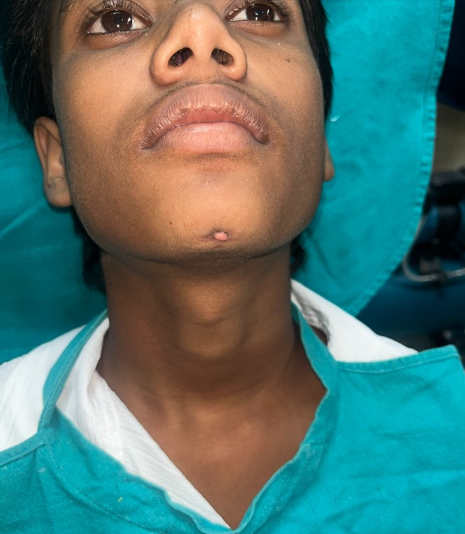 Extra oral sinus case — before treatment