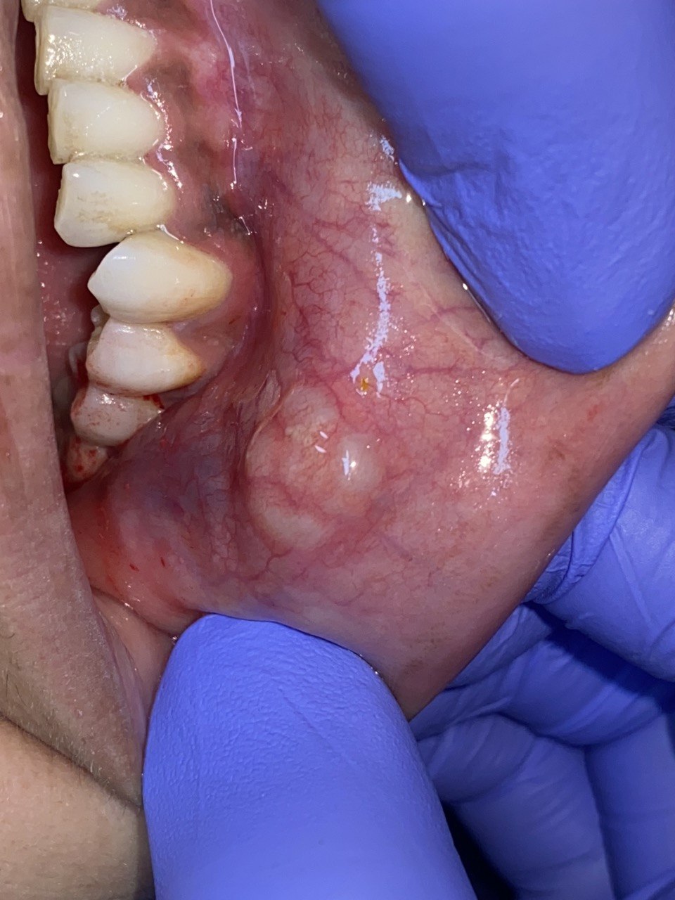 Neuroma case — initial presentation