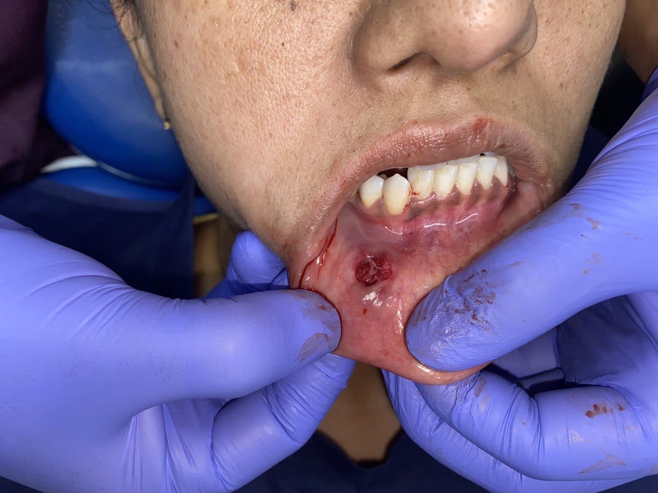 Neuroma case — recovery