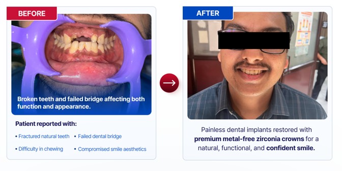Before and after: painless dental implant with zirconia crown
