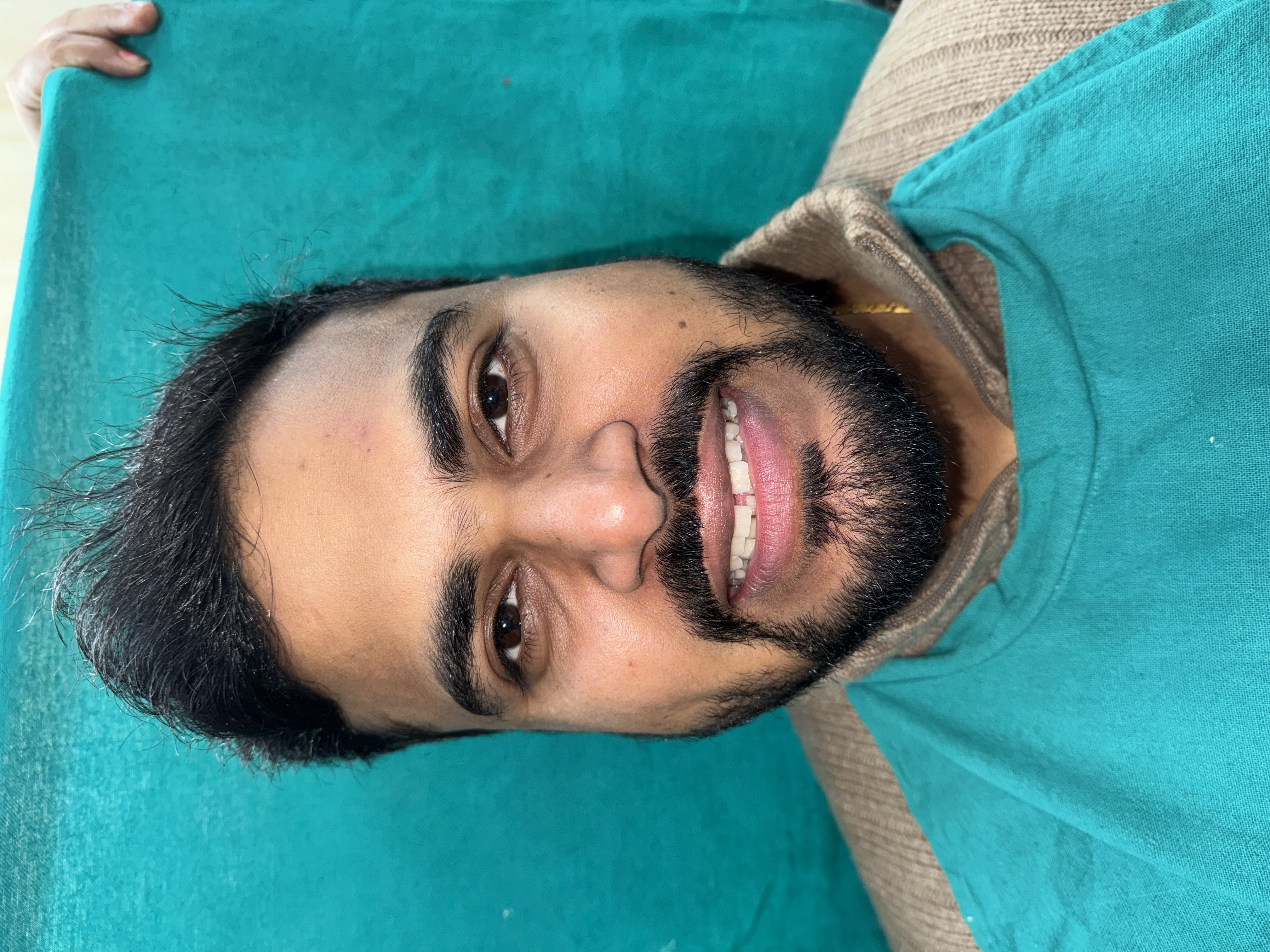 Before: Midline diastema spacing